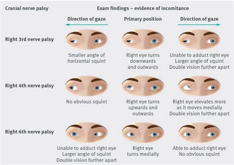 cranial nerve iii palsy - Google Search in 2020 | Cranial nerves ...