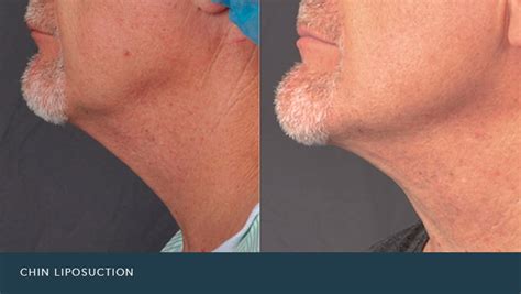 Chin Liposuction Phoenix | Phoenix Liposuction | Phoenix Liposuction