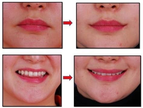 How To Smile With Downturned Lips | Lipstutorial.org