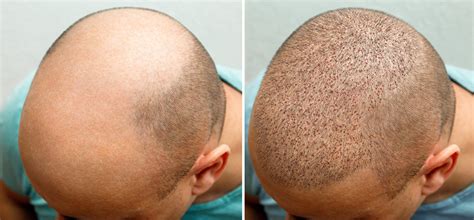 FUE Hair Transplant Before and After Process
