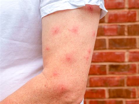 Mosquito Bite Blisters: What Causes Them and How to Treat Them