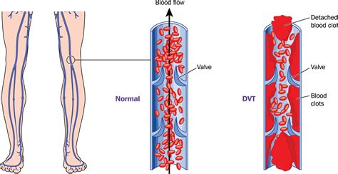 DVT - Deep Vein Thrombosis - Signs, Symptoms, Prophylaxis & Treatment