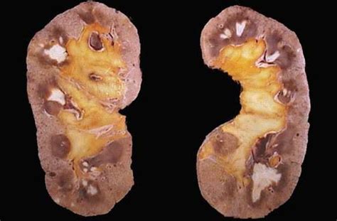 Symptoms of renal papillary necrosis - MEDizzy