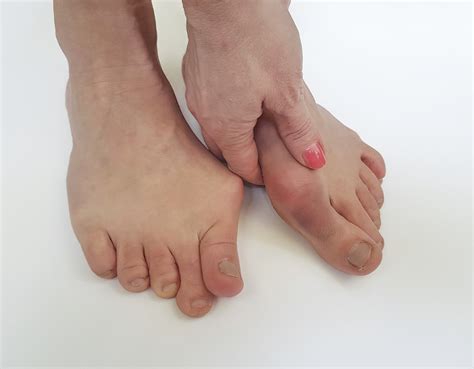 How To Help With Bunion Pain - Cares Healthy