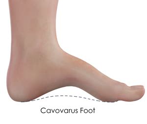 Cavovarus Foot Correction | Advanced Orthopaedics & Sports Medicine, Orthopaedic Specialists ...