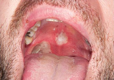 Painful ulcers in mouth | MDedge Family Medicine