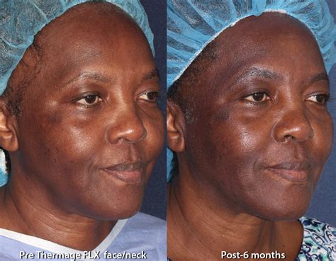 African American Skin Treatments | San Diego, CA | CLDerm