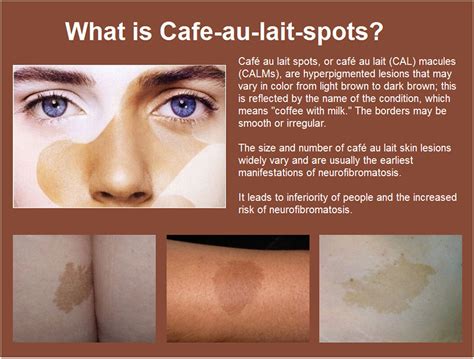 Cafe Au Lait Spots Black Skin - annuitycontract