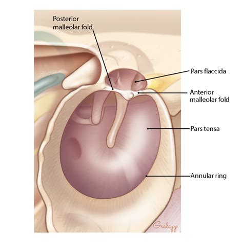 Tympanic Membrane Perforation Repair