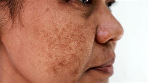 Journal of Aesthetic Nursing - Facial pigmentation and melasma ...