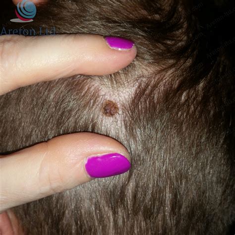 Scalp Mole Removal Case Study – VoltaicPlasma – Areton LTD