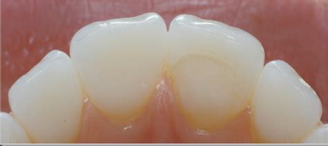 Matching a Single Central: Facial Embrasure Form - Lee Ann Brady DMD