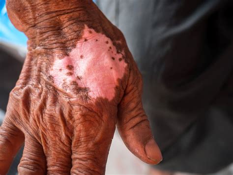 World Leprosy Day: 10 points about this bacteria-driven treatable ...