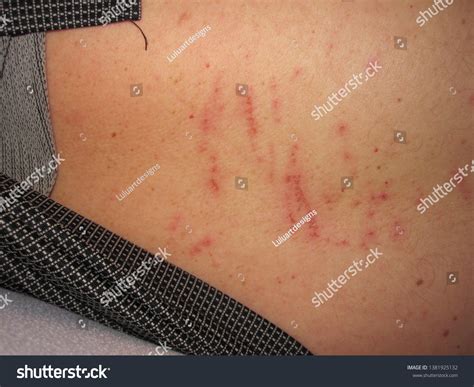 Back Scratches Red Scratches On Back Stock Photo 1381925132 | Shutterstock