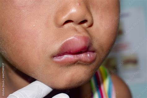 Angioedema at lips of Asian male child. Edematous child. Caused by drug ...