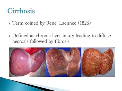 Cirrhosis - Clinical Features