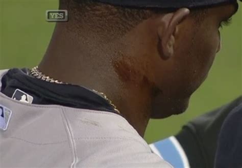 Michael Pineda ejected for having pine tar on his neck | Larry Brown Sports