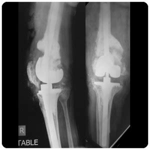 Revision knee replacement surgery - Reasons and examples of