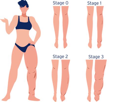 Stages of Lymphedema