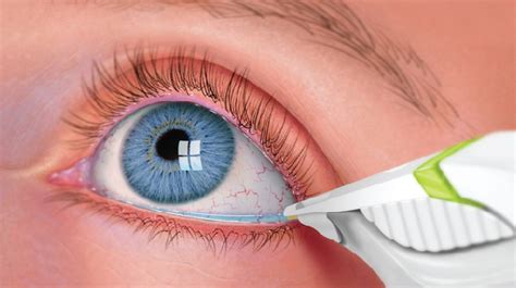 3 Common Eye Infections - Their Symptoms and Treatment| HealthOpinion