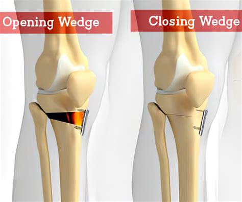 Osteotomy - Types, Risks & Complications