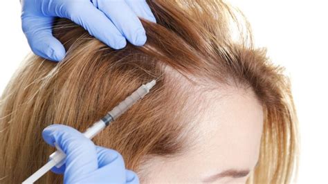 How Often Should You Get PRP Hair Treatment? | Simply.Aesthetics