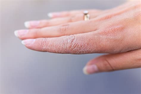5 Immediate Fixes for Dry Hands | Neutrogena®