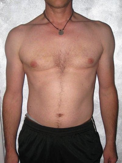 Male Chest - Totally Worth It - Boise - Smart Lipo review - RealSelf