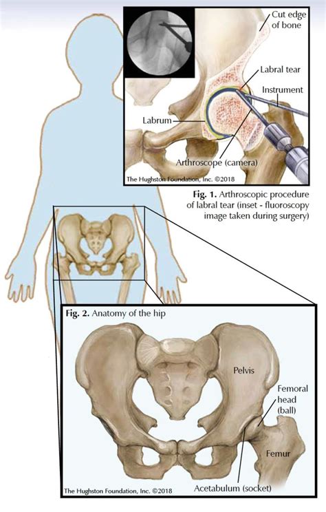 Hip Arthroscopy - Hughston Clinic