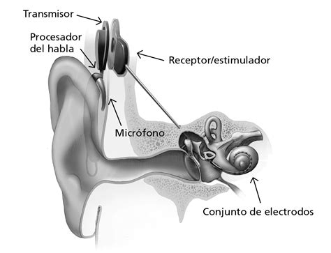 Implantes cocleares: Cómo funciona, quién los recibe | NIDCD