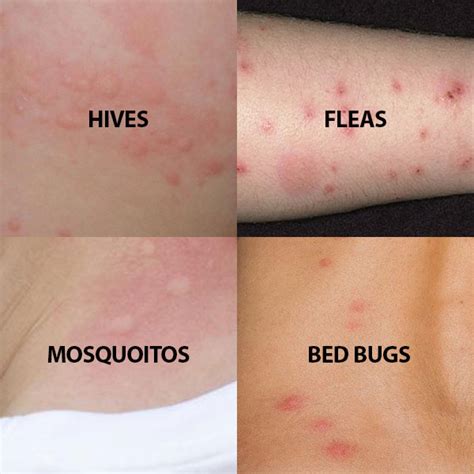 Do Bed Bug Bites And Mosquito Bites Look The Same - Bed Western