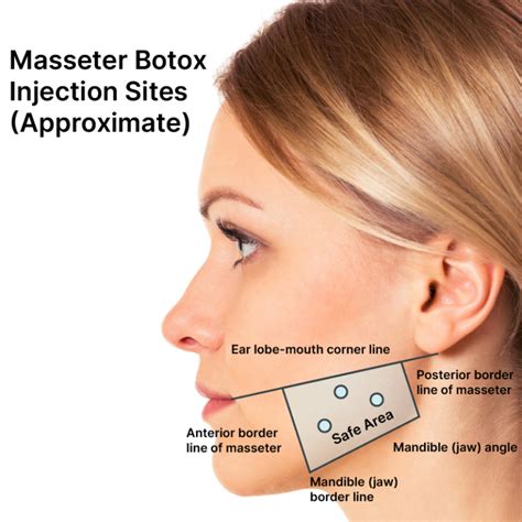 Masseter Botox: Botox for TMJ, Botox for Migraines, Info, Cost
