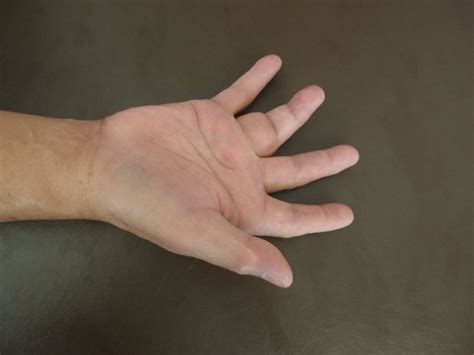 An Enlarging Lump in the Finger | Tumour of the Finger | Giant Cell Tumour of The Phalanx | HC ...