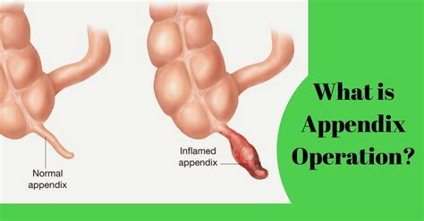 Appendix Removal Surgery in Chennai | Dr Maran Appendix Surgeon