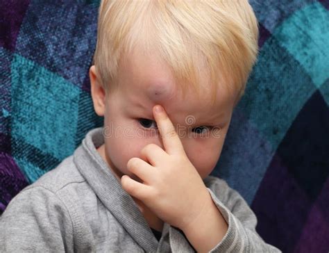 A Big Bruise on the Forehead of a Little Boy Stock Image - Image of ...