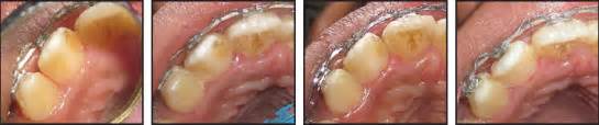 Gradual Grinding of a Talon Cusp During Orthodontic Treatment - JCO ...