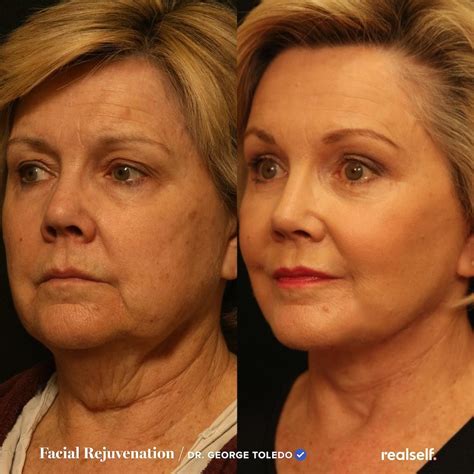 Jowls | Sagging skin face, Face lift surgery, Sagging skin remedies