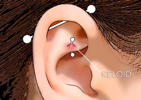 Is It A Keloid Or An Irritation Bump? - Worldwide Tattoo & Piercing Blog