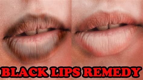 Black Lips Due To Smoking Treatment | Lipstutorial.org