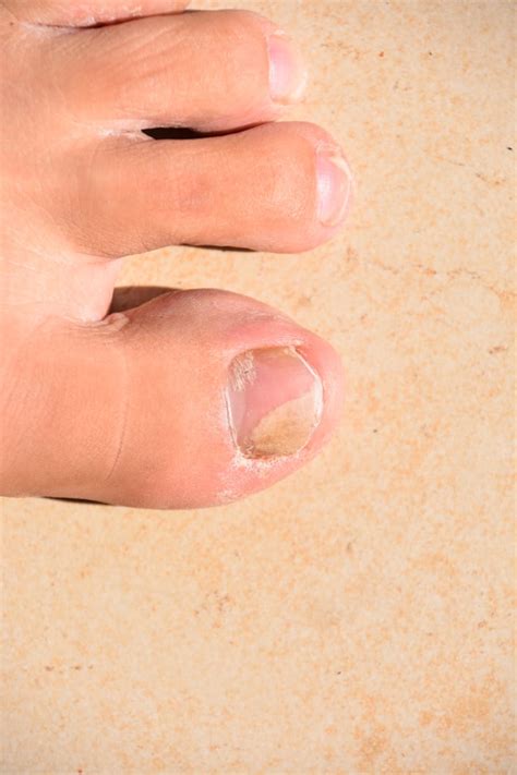 Types Of Toenail Fungus Pictures - Design Talk