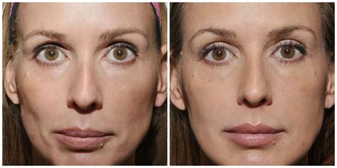 More amazing before and afters of Sculptra. Photos courtesy of Dr ...