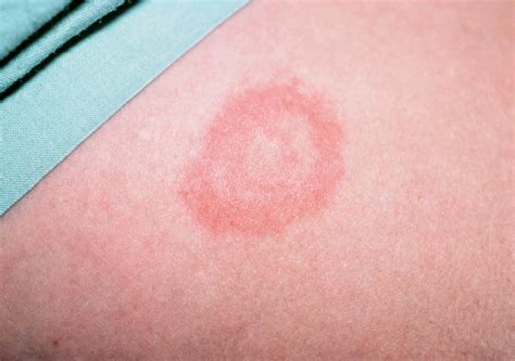 Bull's eye rash is key sign of Lyme disease, leading health watchdog ...