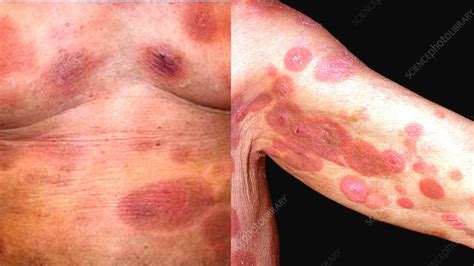 What is Mycosis Fungoides? Symptoms, Causes, Treatment, Diagnosis: Cutaneous T Cell Lymphoma ...