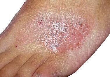 Red Spots On Soles Of Feet - What Causes Red Spots On The Feet Other ...