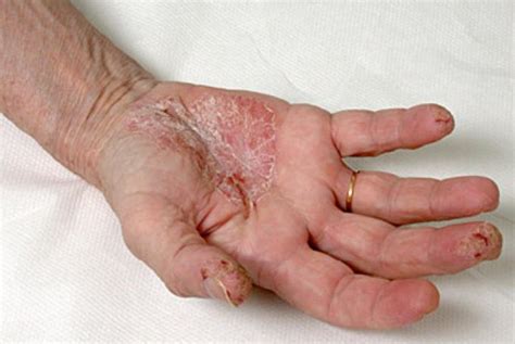 Dyshidrosis, causes, symptoms and treatments