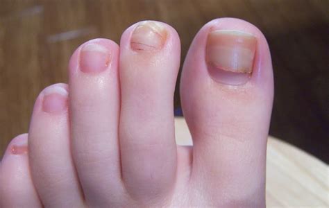 Horizontal Ridges On Toenails A Quick Guide Causes And Treatment | My ...