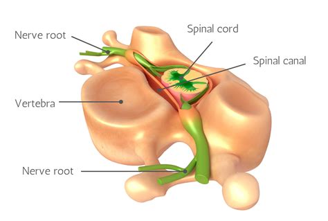 Myelopathy vs Radiculopathy - What's the Difference?