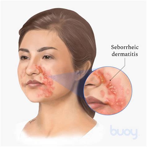 How To Prevent Seborrheic Dermatitis - Crazyscreen21