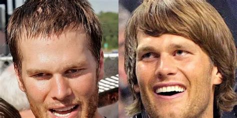 Tom Brady's Hair Transplant: Facts and Details - Hair System