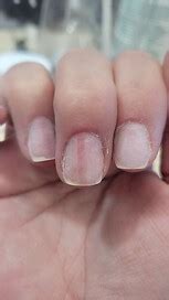 Melanoma Nail Symptoms